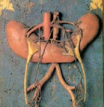 Horseshoe Kidney