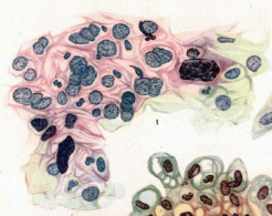 Artist image of High Grade Dysplastic cytology. HSIL